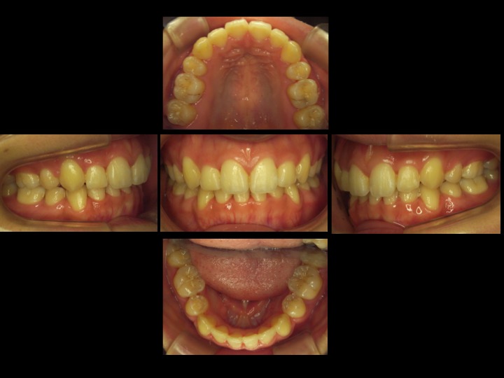 八重歯の矯正術後